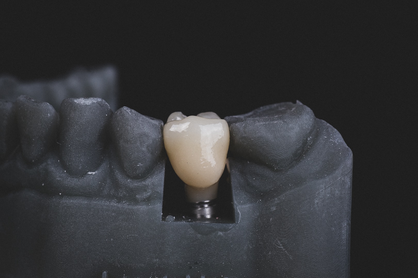 implantatbehandling dentala implantat kbf  skruv bro krona
